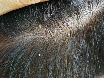 Dandruff