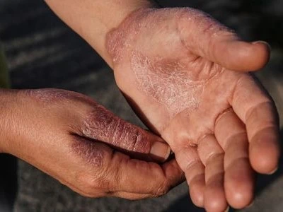 Eczema