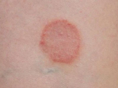 Fungal Infection