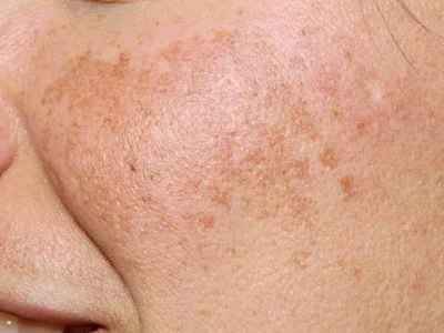 Melasma