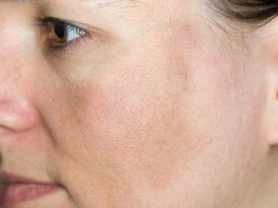 Pigmentation