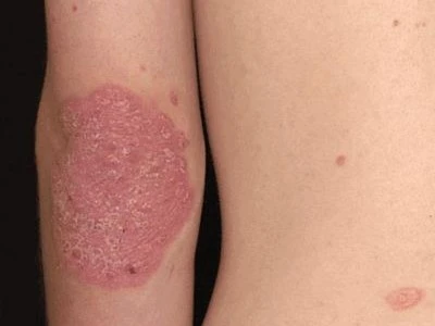 Psoriasis